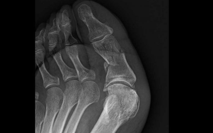 Xray of my big toe for article on Doctors' Health by Dr Anne Malatt